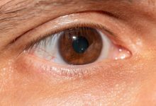 Glaucoma pseudoesfoliativo