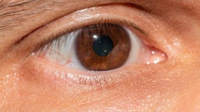 Glaucoma pseudoesfoliativo
